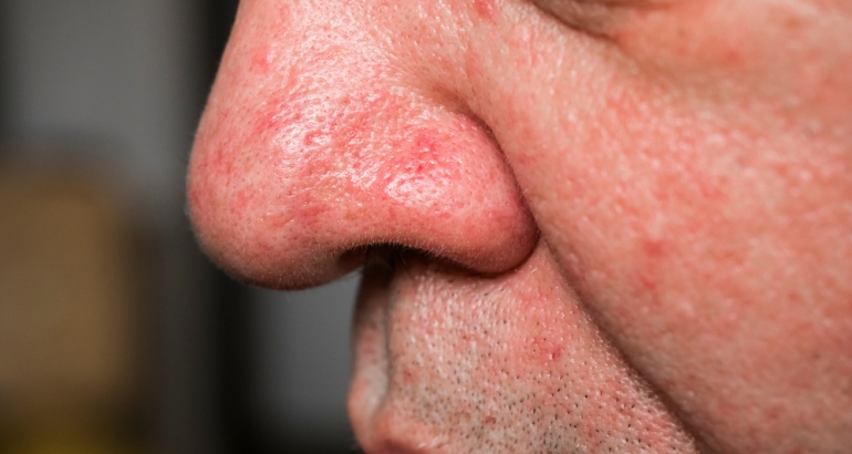 Facial Vein Treatments For Men